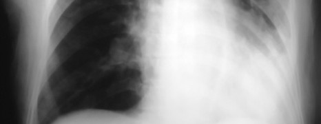 Zápal plic - pneumonie